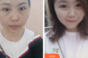 江門?？滇t(yī)學(xué)整形美容醫(yī)院李嘉欣整形價(jià)格表附祛雀斑案例展示