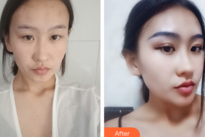 江門?？滇t(yī)學(xué)整形美容醫(yī)院付洪波整形價(jià)格表附眼部手術(shù)案例展示