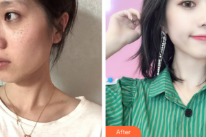 江門?？滇t(yī)學(xué)整形美容醫(yī)院蔡劍芳整形價(jià)格表附激光美膚激光祛斑案例展示