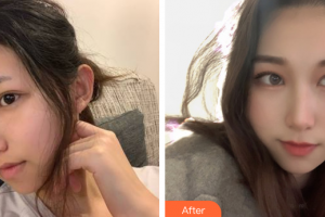 江門僑都華美美容醫(yī)院歐國升整形價(jià)格表附面部填充案例展示