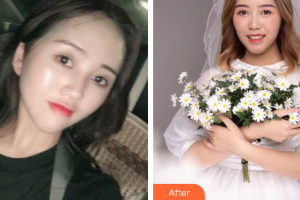 江門僑都華美美容醫(yī)院常海整形價(jià)格表附眼部整形案例展示