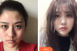 湛江澳泰整形美容醫(yī)院彭新 整形價(jià)格表附激光去眼袋案例展示