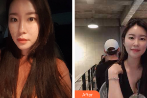 肇慶華美整形美容醫(yī)院涂成芳整形價格表附激光祛痘案例展示