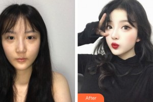 河南整形美容醫(yī)院支凌翔整形價(jià)格表附隆鼻手術(shù)案例展示
