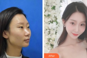 河南省人民醫(yī)院整形美容中心侴海燕整形價格表附鼻部手術(shù)案例展示