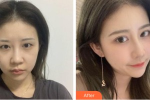 河南協(xié)和醫(yī)院整形外科騰利整形價(jià)格表附眼部手術(shù)案例展示