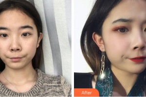 河南省煤炭總醫(yī)院激光整形中心張新華整形價(jià)格表附皮膚美容案例展示