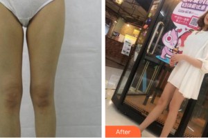 河南艾斯醫(yī)療美容醫(yī)院黃仲立整形價(jià)格表附大腿吸脂案例展示