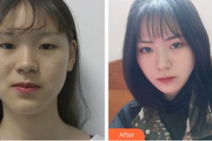 河南大學(xué)第一附屬醫(yī)院醫(yī)療美容科馬杰整形價(jià)格表附雙眼皮手術(shù)案例展示