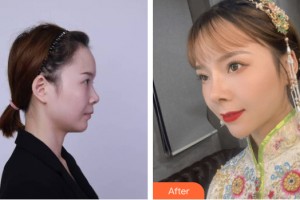 武警河南省總隊(duì)醫(yī)院激光整形中心解邦杰整形價(jià)格表附鼻部手術(shù)案例展示
