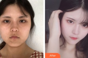 河南整形美容醫(yī)院楊萬忠整形價(jià)格表附皮膚美容案例展示