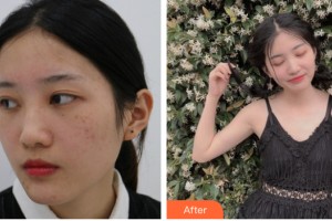 河南整形美容醫(yī)院尹彩霞整形價(jià)格表附皮膚美容案例展示