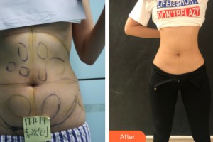 河南中醫(yī)藥大學(xué)第一附屬醫(yī)院整形美容科郭金冉整形價(jià)格表附腰腹吸脂案例展示