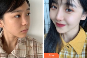 河南一科整形美容醫(yī)院吳利永整形價(jià)格表附隆鼻手術(shù)案例展示
