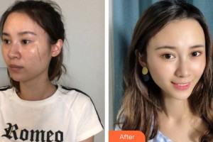 河南宏力醫(yī)院燒傷整形科張彬宇整形價(jià)格表附皮膚美容案例展示