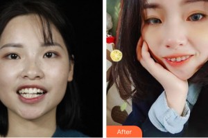 海南泰康拜博口腔醫(yī)院顏福壯整形價(jià)格表附牙齒矯正案例展示