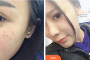 廣東藥科大學附屬第一醫(yī)院醫(yī)療美容科單孔榮整形價格表附激光祛斑案例展示