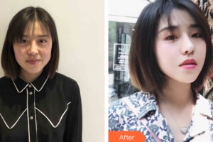海南整形美容醫(yī)院林蔚茜整形價(jià)格表附皮膚美容案例展示