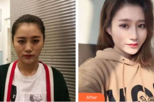 海南現(xiàn)代婦嬰醫(yī)院醫(yī)療美容科賀建疆整形價(jià)格表附隆鼻手術(shù)案例展示