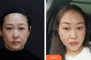 海南省人民醫(yī)院激光美容整形科游文健整形價(jià)格表附皮膚美容案例展示