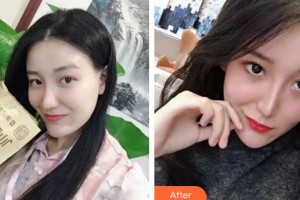 云南華美美萊美容醫(yī)院黃夢婷整形價(jià)格表附清潔祛痘案例展示