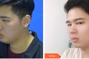 云南銅雀臺(tái)整形美容醫(yī)院李信奎院長整形價(jià)格表附減脂案例展示
