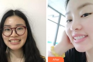 海南南方天涯口腔醫(yī)院付少平整形價格表附牙齒矯正案例展示