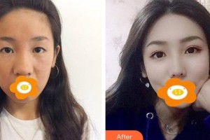 云南銅雀臺整形美容醫(yī)院周柯院長整形價(jià)格表附鼻部綜合案例展示