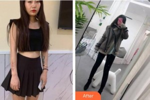 云南銅雀臺整形美容醫(yī)院鄧皓仁院長整形價(jià)格表附激光祛疤案例展示
