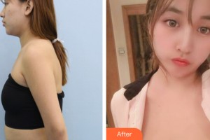 海南添美整形外科診所金泳泰整形價格表附隆胸手術(shù)案例展示