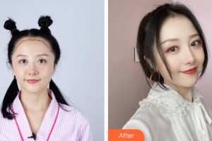 海南韓美醫(yī)學(xué)美容醫(yī)院胡譯園整形價(jià)格表附植發(fā)案例展示
