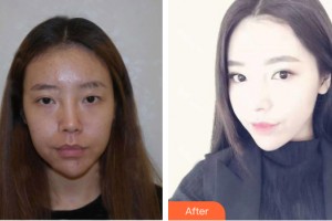 南寧夢想DREAM整形醫(yī)院萬偉東整形價格表附鼻部手術案例展示