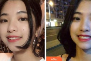 昆明前衛(wèi)美眼整形?？圃\所劉流整形價(jià)格表附牙齒隱形矯正案例展示