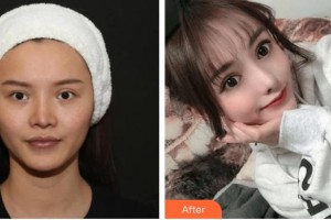 昆明都市儷人美容醫(yī)院蔡瑞整形價(jià)格表附假體墊眉弓案例展示