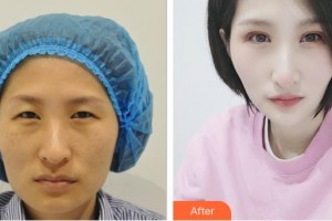昆明美伊萊醫(yī)療美容門(mén)診部陳玉瓊整形價(jià)格表附眼部修復(fù)例展示
