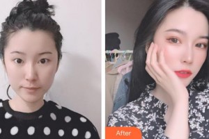 昆明達(dá)美醫(yī)療美容診所楊光華整形價(jià)格表附切開(kāi)雙眼皮案例展示