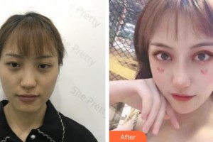 昆明前衛(wèi)美眼整形專科診所吳瓊整形價(jià)格表附切開(kāi)雙眼皮案例展示
