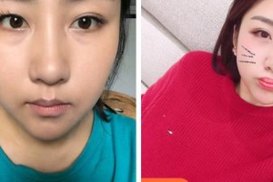昆明美立方（原大華）醫(yī)療美容醫(yī)院晉超整形價(jià)格表附切開(kāi)雙眼皮案例展示