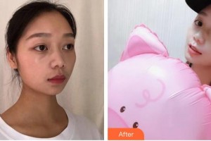 昆明華山眼科醫(yī)院何雨檀整形價格表附水氧活膚案例展示