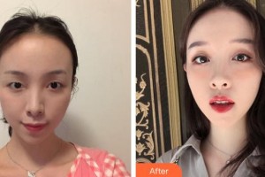 昆明醫(yī)科大學第一附屬醫(yī)院整形外科李逸松整形價格表附切開雙眼皮案例展示