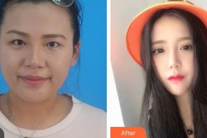 昆明醫(yī)科大學(xué)第二附屬醫(yī)院整形外科王繼華整形價(jià)格表附切開(kāi)雙眼皮案例展示