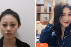 南寧夢想DREAM整形醫(yī)院高山整形價格表附隆鼻手術案例展示