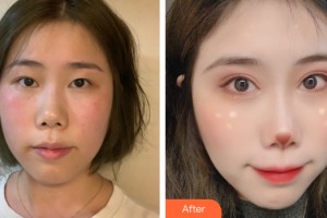 南寧達(dá)美整形美容醫(yī)院邢文明整形價格表附眼部手術(shù)案例展示