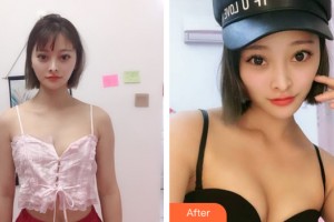 南寧夢想DREAM整形醫(yī)院劉正源整形價格表附自體脂肪豐胸案例展示