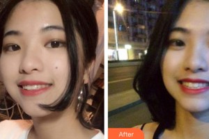 南寧市第七人民醫(yī)院整形美容科盧鏡香整形價格表附牙齒矯正案例展示