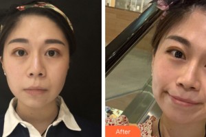 南寧悅星貞韓美容整形醫(yī)院張媛整形價格表附皮膚美容案例展示