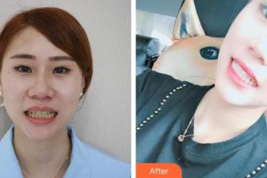 昆明拜博口腔醫(yī)院羅金燕整形價(jià)格表附美白劑美白牙齒案例展示