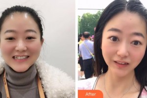 昆明拜博口腔醫(yī)院吳艷芳整形價(jià)格表附牙齒隱形矯正案例展示