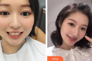 昆明尚愛韓美口腔門診部孫亞杰整形價格表附美白劑美白牙齒案例展示