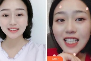 昆明愛雅仕口腔醫(yī)院劉欣整形價格表附金屬托槽矯正案例展示